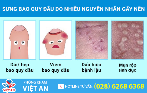 Sưng bao quy đầu do nhiều nguyên nhân gây nên