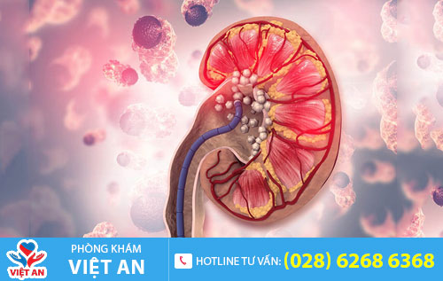 Bệnh sỏi thận
