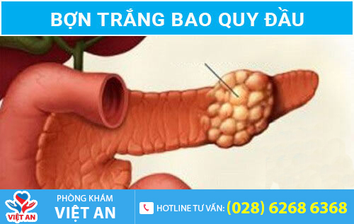 Hình ảnh bợn trắng bao quy đầu