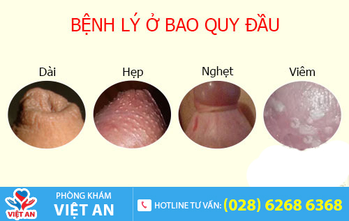Tình trạng bất thường cảnh báo bệnh lý ở bao quy đầu