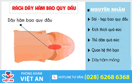 Có nên cắt dây hãm bao quy đầu?