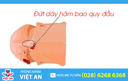 Đứt dây hãm bao quy đầu