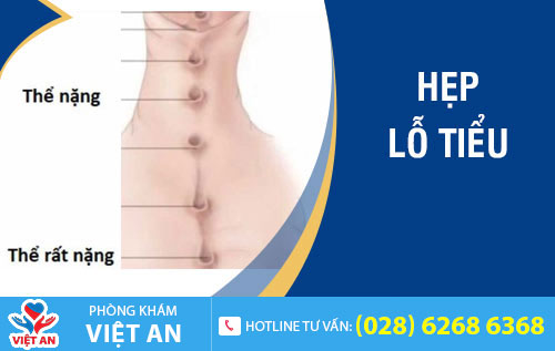 hẹp lỗ tiểu