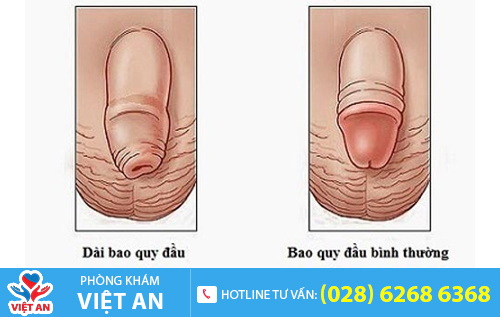 Hình ảnh dài bao quy đầu