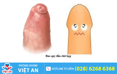 Hình ảnh hẹp bao quy đầu ở người lớn