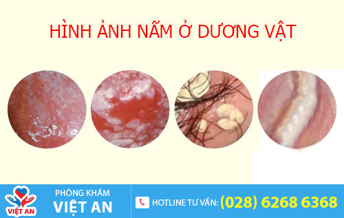 Hình ảnh nấm dương vật