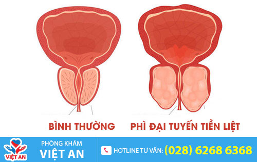 Hình ảnh phì đại tuyến tiền liệt
