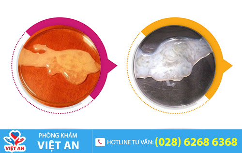 Hình ảnh tinh trùng đặc, tinh trùng vón cục