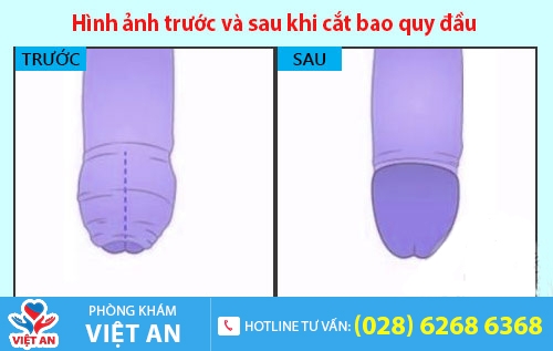 Hình ảnh trước và sau khi cắt bao quy đầu
