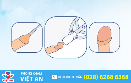 Cắt bao quy đầu
