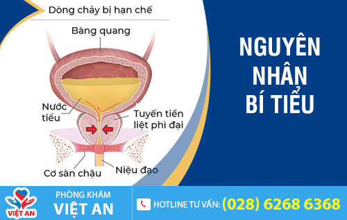 Nguyên nhân gây bí tiểu