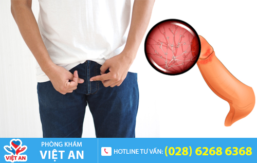 Nấm bao quy đầu ở nam giới