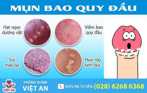 Hình ảnh nổi mụn bao quy đầu