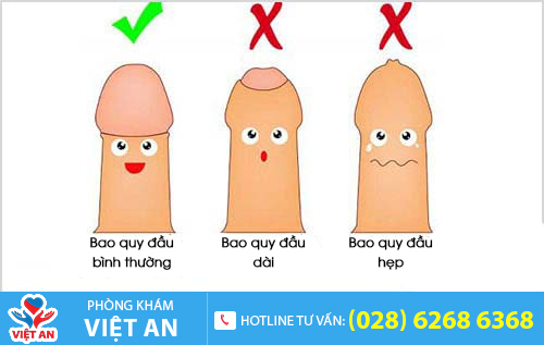 Các dạng bệnh lý cần cắt da bao quy đầu