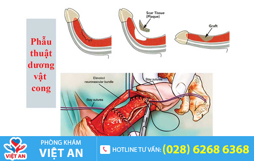 Biến chứng cong dương vật do kỹ thuật khâu không đúng cách