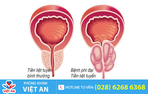Phì đại tuyến tiền liệt