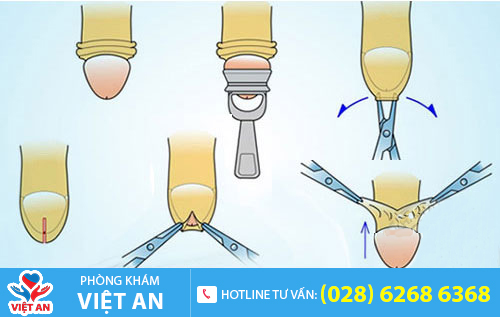 Phương pháp cắt bao quy đầu hiện đại