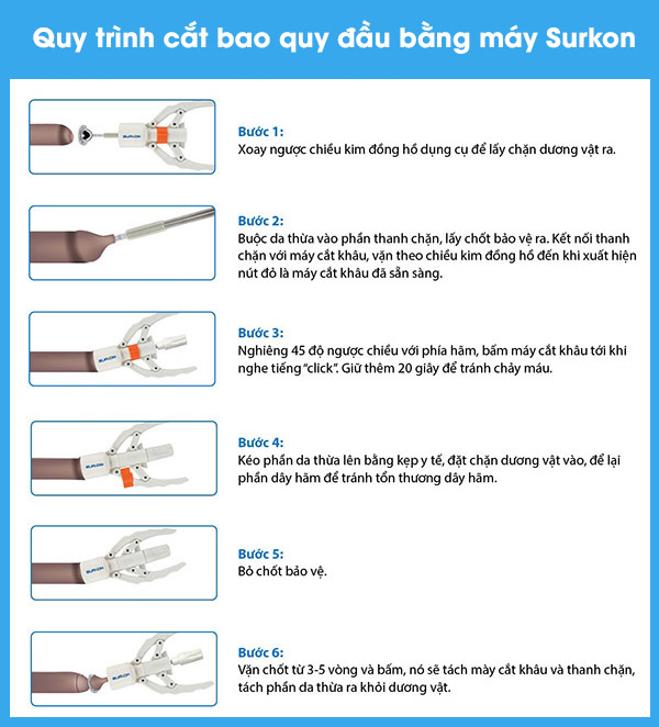 Quy trình cắt bao quy đầu bằng máy Surkon