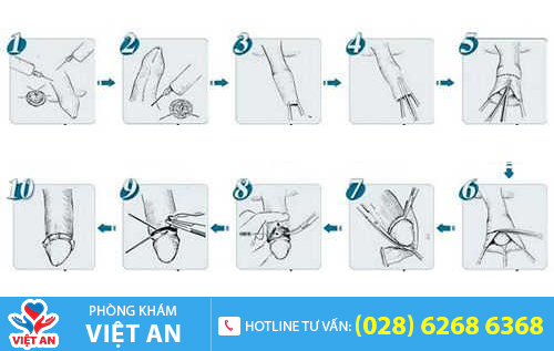 Quy trình cắt bao quy đầu theo công nghệ hiện đại
