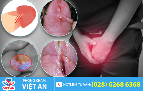 Hình ảnh rách bao quy đầu