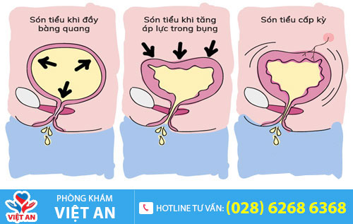 Són tiểu ở nam giới
