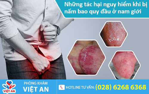 Những tác hại nguy hiểm khi bị nấm bao quy đầu ở nam giới