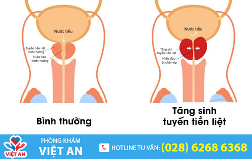 Tăng sinh tuyến tiền liệt