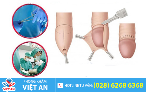 Tiểu phẫu thông nối cắt bao quy đầu tự hào là kỹ thuật tốt và hiện đại
