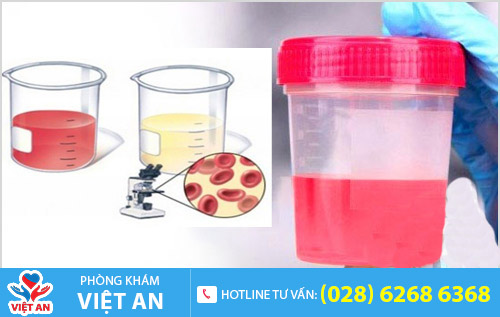 Tiểu ra máu đại thể và vi thể ở nam giới