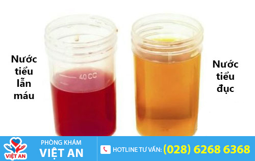 Nước tiểu đục, có lẫn máu là triệu chứng viêm đường tiết niệu ở nam và nữ