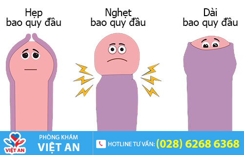 Nam giới có bao quy đầu dài, hẹp nên thực hiện cắt bao quy đầu