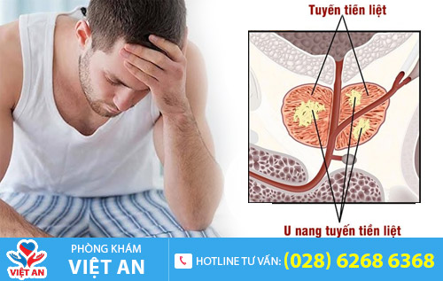 u nang tuyến tiền liệt
