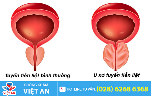 U xơ tuyến tiền liệt