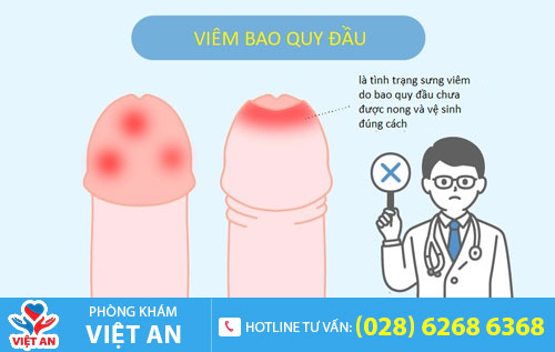 Viêm bao quy đầu gây lở loét bao quy đầu