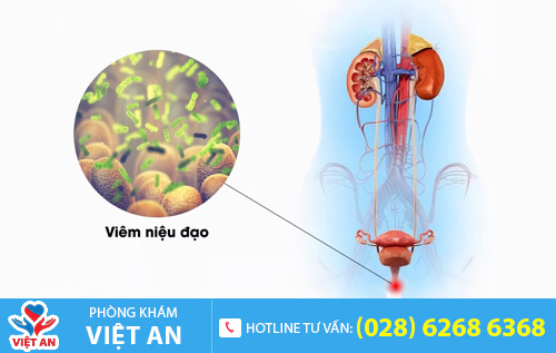 Viêm niệu đạo