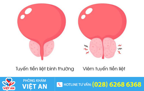 Viêm tuyến tiền liệt