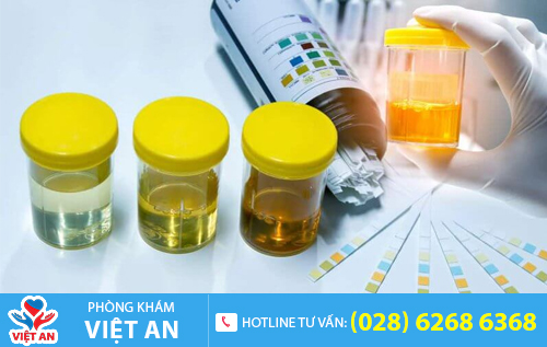 Xét nghiệm nước tiểu giúp phát hiện nhiều bệnh