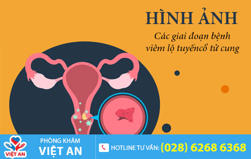 Hình ảnh viêm lộ tuyến cổ tử cung