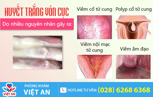 Nguyên nhân huyết trắng vón cục