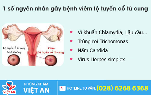 Nguyên nhân viêm lộ tuyến