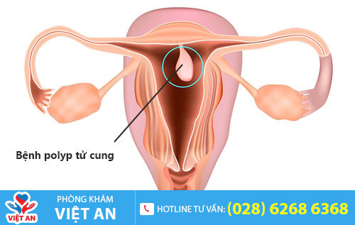 Polyp tử cung