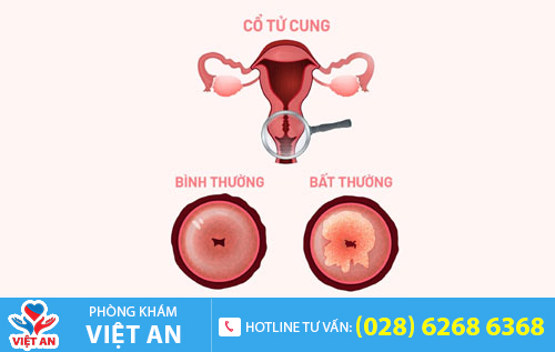 Viêm cổ tử cung