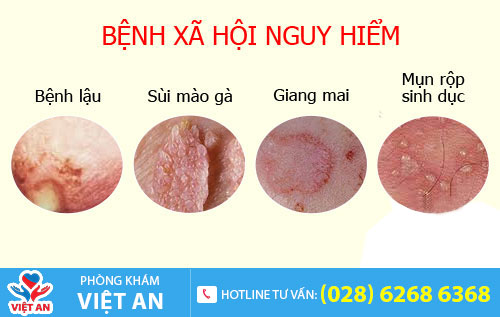 Bệnh xã gây đau bụng dưới