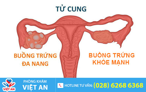 đa năng buồng trứng