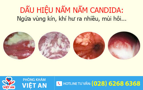 Dấu hiệu nhiễm nấm candida