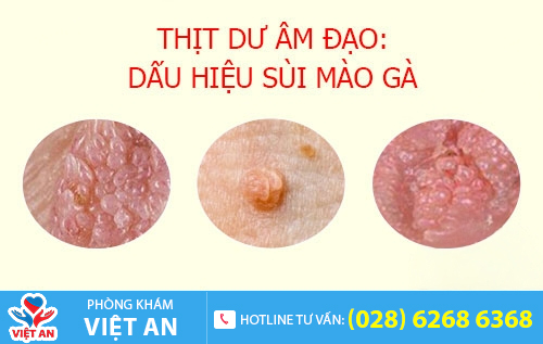 dấu hiệu sùi mào gà