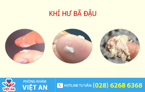 Hiện tượng khí hư bả đậu