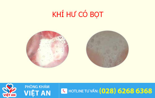 Khí hư có bọt