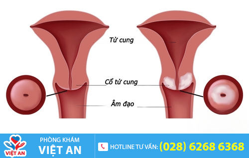 Các bệnh tử cung, cổ tử cung khiến kinh nguyệt có mùi hôi tanh