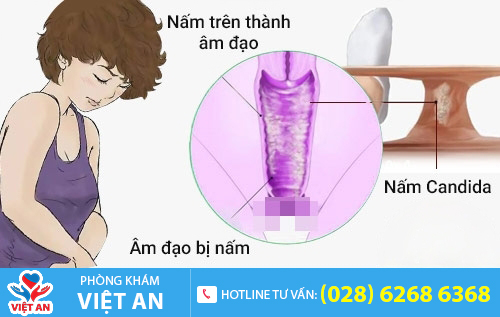 Sưng vùng kín do nấm âm đạo